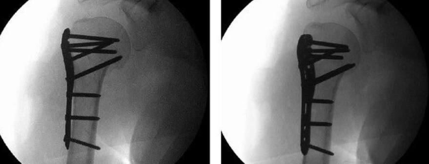  肱骨近端骨折术中透视技巧