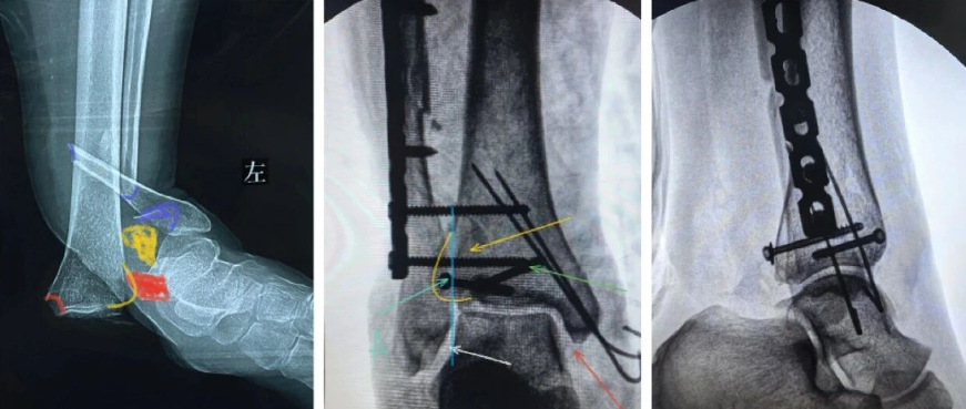 怎么做开放踝关节骨折脱位，高清图解！