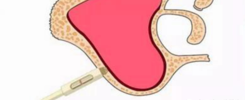 一文读懂与上颌窦提升术相关的上颌窦囊性病变!