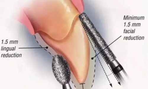 备牙常被忽略的一些问题