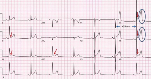 多变的T波,如何鉴别及危险分层?