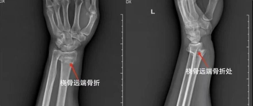 一文读懂：桡骨远端（克雷氏）骨折复位法