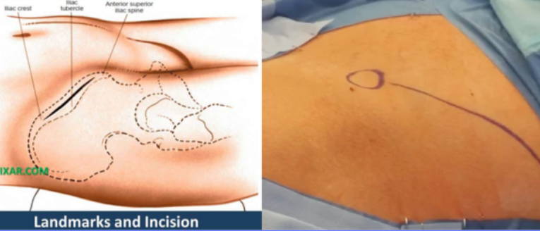 骨科基本技术：成人髂前棘骨移植物获取方法总结
