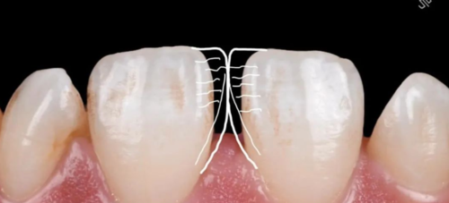 使用GC复合树脂关闭牙间隙,这16张图片讲清楚了