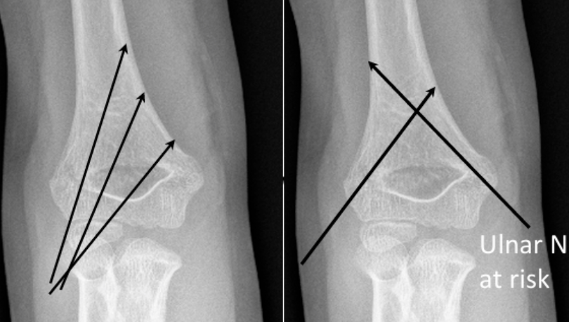 致命的“内侧针”：儿童肱骨髁上骨折术后新发尺神经损伤，立即拔针就对了吗？