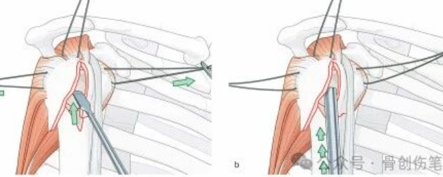 肱骨近端骨折的复位与固定技术AO版