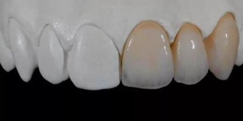 做烤瓷牙为什么要留金属边?