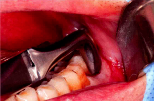 牙拔除术后即刻位点保存术的操作技巧