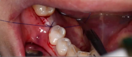 种植医生必看:掌握骨结合与种植体选择的临床关键点