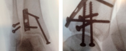手术“金标准”:后外侧入路固定后踝骨折的手术步骤详解(JBJS经验)