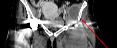 全髋关节置换术后关节周围积液的症状:是败血症还是无菌并发症?