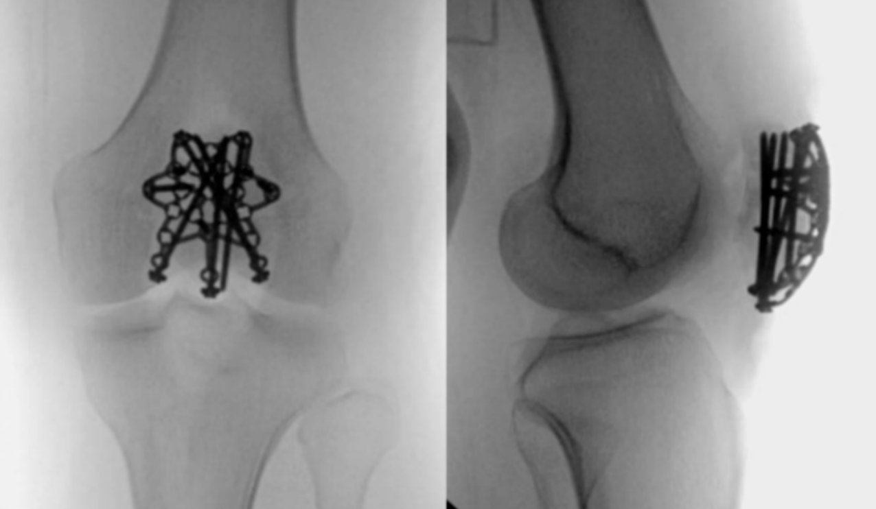 髌骨骨折治疗新进展（2024）