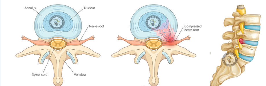 腰椎间盘突出症运动康复的专家共识（2025年）
