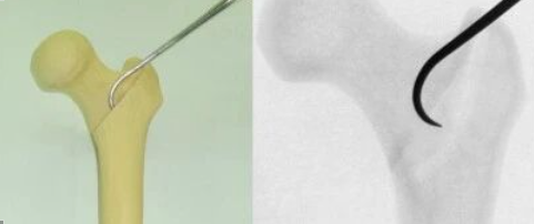 早读 | 股骨粗隆间骨折复位的钩杆撬拨技术