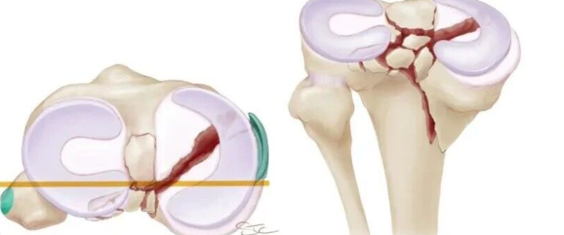 【一文综述】了解胫骨平台骨折的复位标准