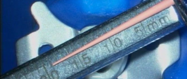 热牙胶充填操作技术全图解，经典收藏值得学习！