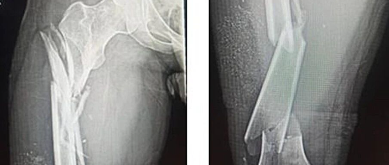 微创双钢板桥接固定治疗复杂股骨骨折！