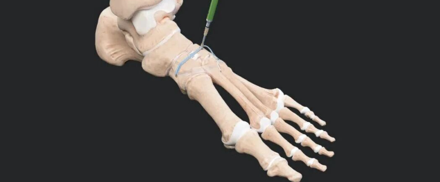 手术技巧 | 微创TightRope弹性固定单纯性Lisfranc韧带损伤