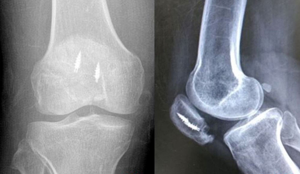 ​髌骨下极粉碎性骨折的缝线桥锚钉固定技术