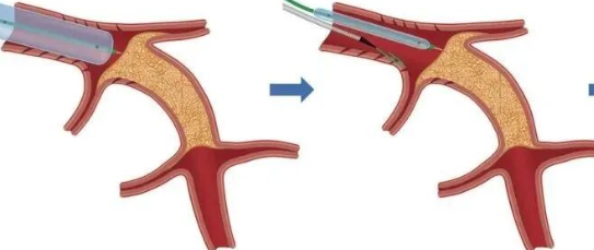 【医学科普】CTO介入路径推荐