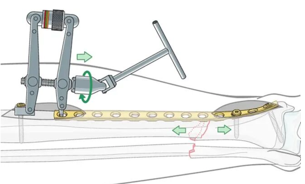 胫骨简单横形骨折的MIPO加压钢板内固定AO指南