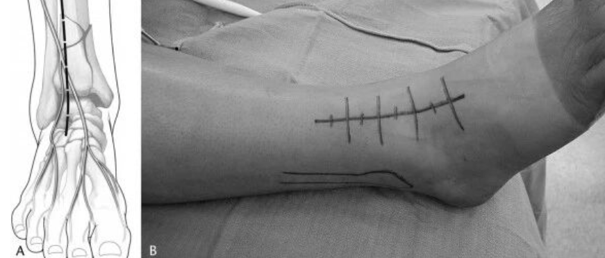 步步为“赢”：Pilon骨折前外侧入路手术全流程与关键技巧