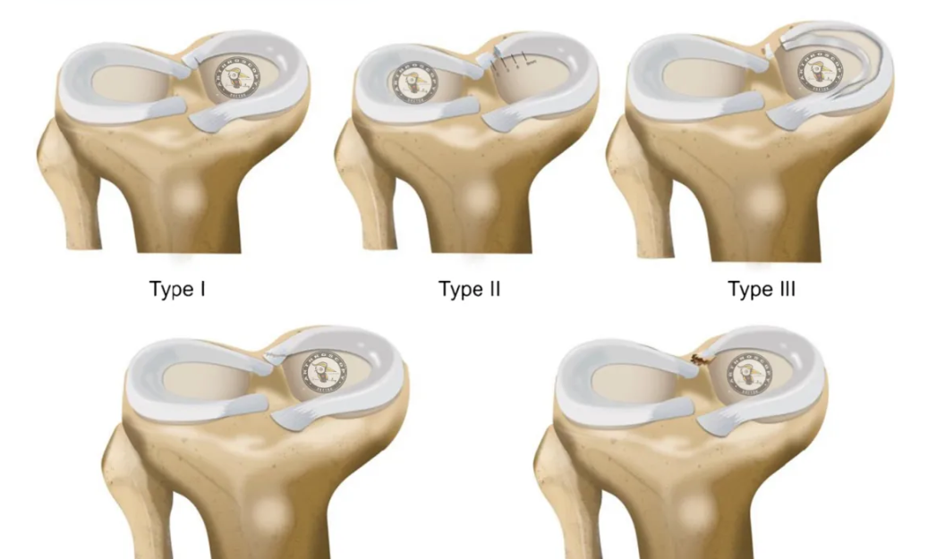 【它山之石】国际专家共识：内侧半月板根部撕裂的诊断、治疗和康复（2025年）