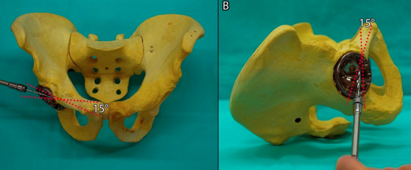 初次和翻修全髋关节置换术中髋臼螺钉的置入，掌握要点看这篇！