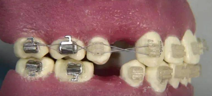 正畸操作小技巧：尖牙向后结扎