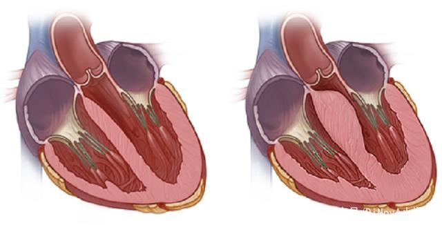 中国肥厚型心肌病诊断及分型