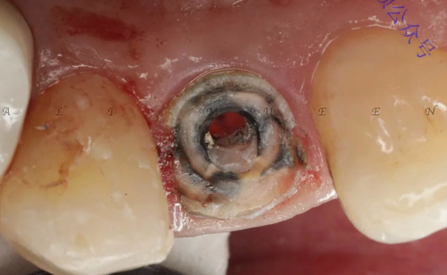 看一个利用箍效应的修复