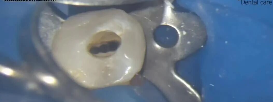 次氯酸钠在根管治疗到底怎么用？这篇文章指导性很强