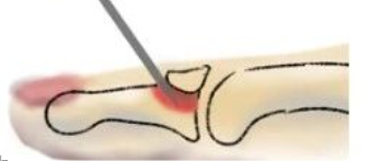 ​手术技巧 | 反“石黑法”治疗复杂的垂状指及6个手术技巧