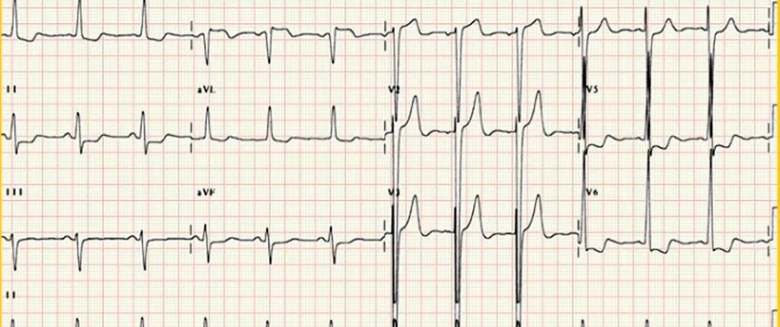ST段抬高的识别及相关疾病的鉴别，这篇文章给你讲清楚了！