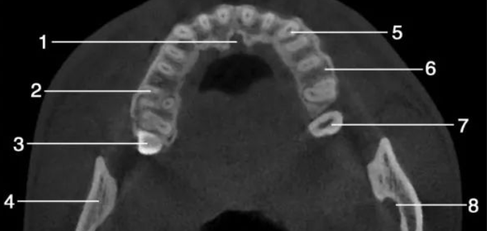 上颌骨CBCT影像图谱大全！值得收藏！