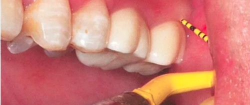 种植修复距离不足的解决办法(一)