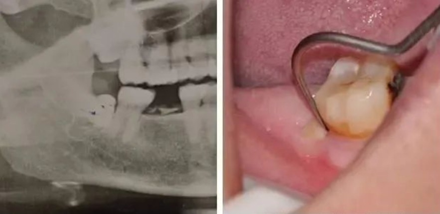 拔智齿前的阻力评估，本文适合年轻牙医