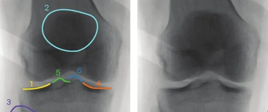 胫骨平台术中如何透视标准？内外侧平台如何分别透视？看这篇AO指南！