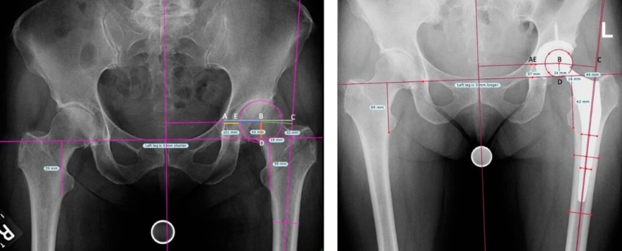 THA：旋转中心内移可降低近3倍臼杯松动风险
