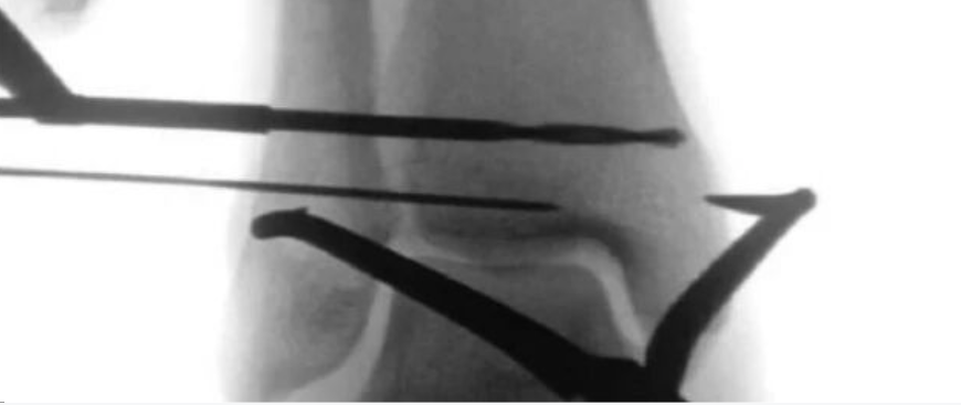 踝关节之下胫腓联合损伤，怎么看？怎么内固定？怎么避坑？