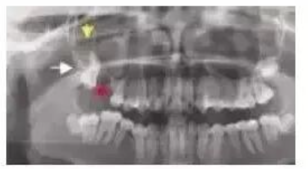 上颌第一磨牙全牙进入上颌窦，如何处理？