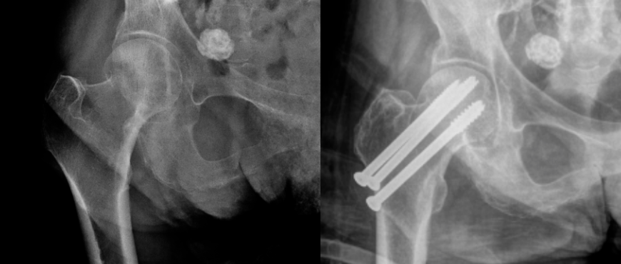 髋部骨折：相关解剖学、分型、治疗、骨折的生物力学，一文讲清！