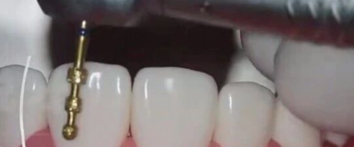 开窗 vs 包绕式瓷贴面,如何选不踩坑?