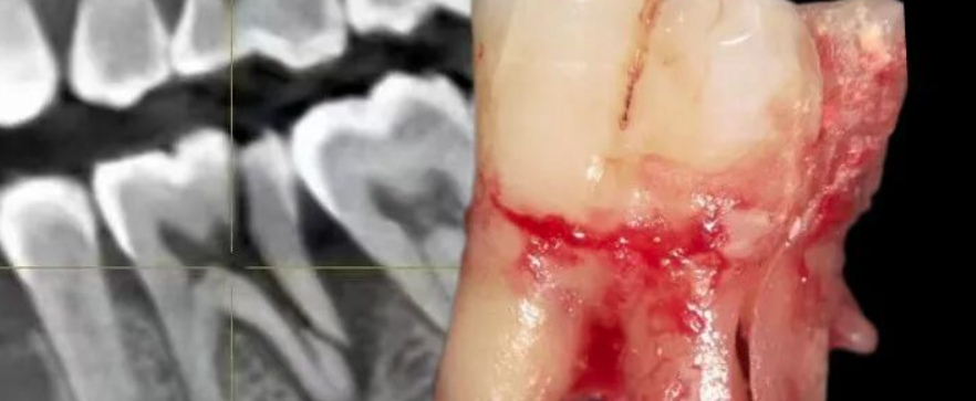 好牙都能咬劈，何况治疗过的牙你还不做冠！