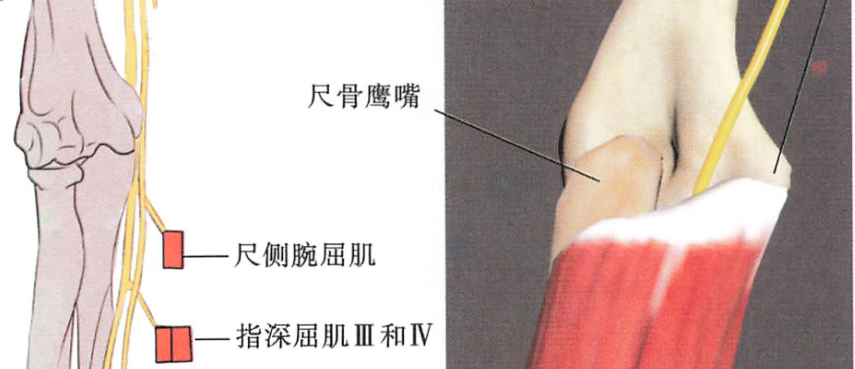 肘管综合征诊疗方案专家共识（2025版） 