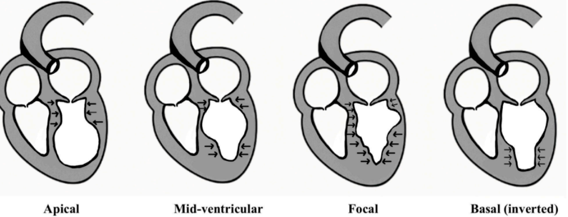 takotsubo 综合征，你了解多少，最新进展看这篇！