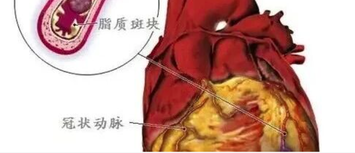 急性ST段抬高型心肌梗死（心梗）静脉溶栓流程清单