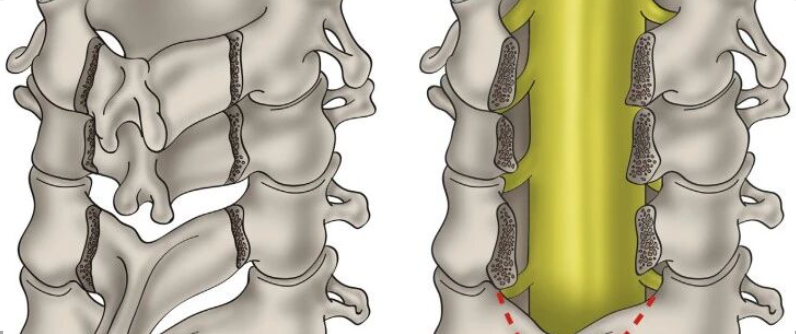 简单明了的脊柱减压技巧，骨科医生必看！