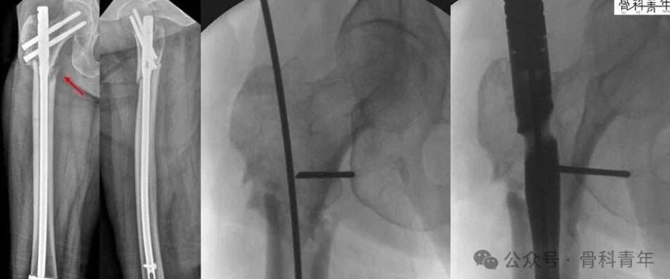 粗隆下骨折，如何巧妙使用“阻挡钉”？