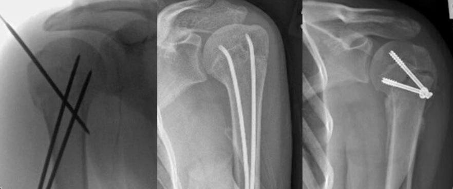 儿童肱骨近端骨折的治疗